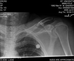 clavicle